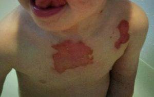 first aid for burns