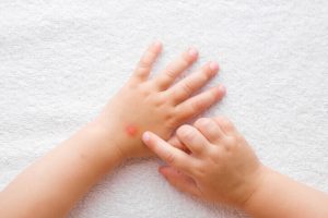 first aid for insect bites and stings